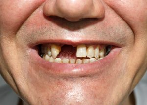sorriso-sem-dentes-68112913-300x215 Promotoria de Justiça recomenda que Prefeitura de Sumé conclua tratamentos dentários de pacientes