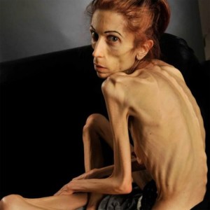 anorexia-300x300 Americana que pesava 18 kg mostra recuperação pós-anorexia  bancada com doações online