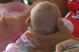 microcefalia-1-300x200 Região do Cariri registra morte de dois bebês com suspeita de microcefalia