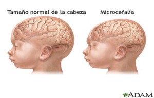 microcefalia-300x192 Casos de microcefalia aumentam na PB, segundo o Ministério da Saúde