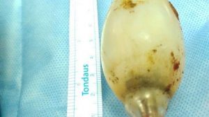 Lampada-300x169-300x169 Médicos encontram lâmpada dentro do estômago de homem