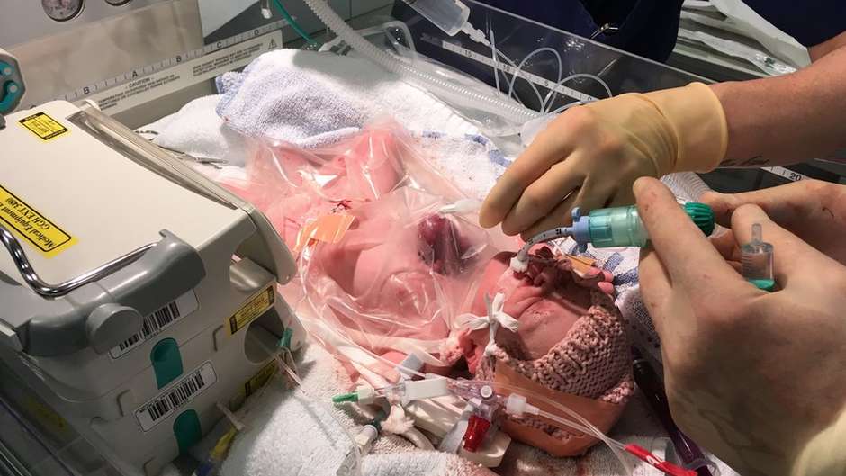 CORACAO-FORA-DO-PEITO Bebê que nasceu com coração fora do corpo supera expectativas e se recupera