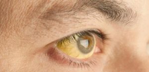 16012018174333-300x146 Holanda confirma caso de febre amarela contraída por um homem no Brasil
