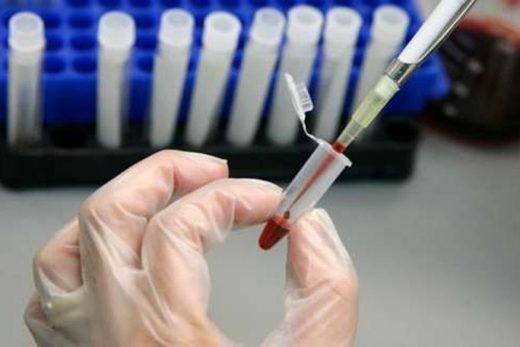 hiv-520x347 Cientistas relatam segundo caso de cura do HIV após transplante