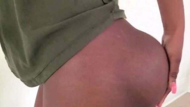 NADEGAS-SILICONE Mulher vive drama com implantes de silicone nas nádegas