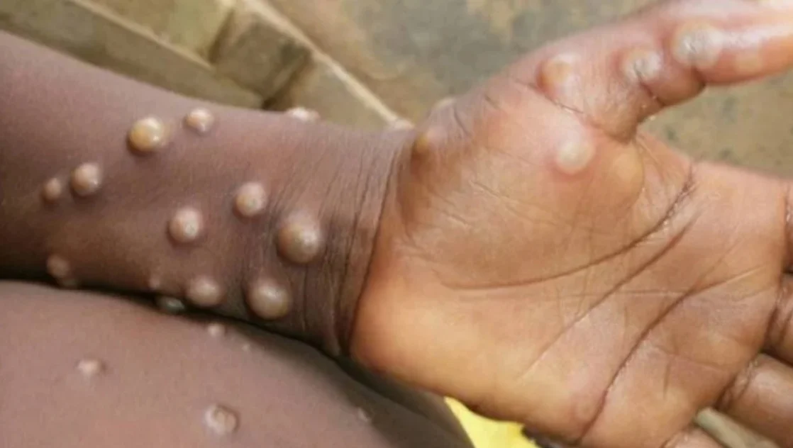 variola-dos-macacos Novos casos de varíola dos macacos geram dúvidas sobre prevenção e tratamento