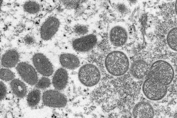 monkeypox-599x400 Confirmado segundo caso de varíola dos macacos no Brasil