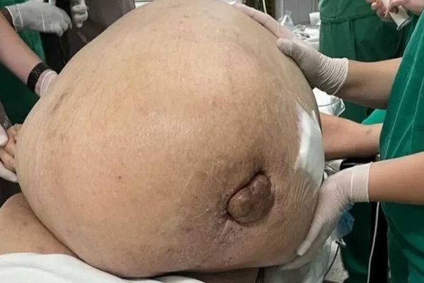 tumor-599x400 Tumor com cerca de 46 kg é retirado de mulher em cirurgia de emergência