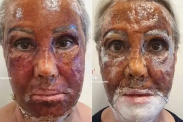 peeling-de-fenol-599x400 Procedimento estético faz mulher 'trocar de rosto' e mudança viraliza