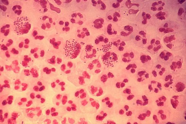 1638px-gonococcal-urethritis-phil-4085-lores-599x400 Supergonorreia: cientistas encontram cepa resistente a antibióticos nos EUA