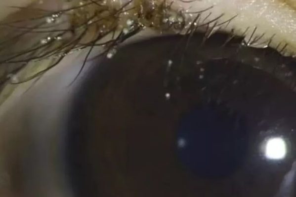 olhos_piolhos____foto_reproducao-599x400 Criança de três anos é diagnosticada com infestação de piolhos e lêndeas na região dos olhos