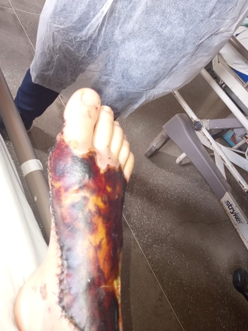 IMG-20231119-WA0381 Monteirense que sofreu acidente de moto na rua do Campo, corre risco de ter pé amputado, pede ajuda para se manter enquanto aguarda cirurgias.