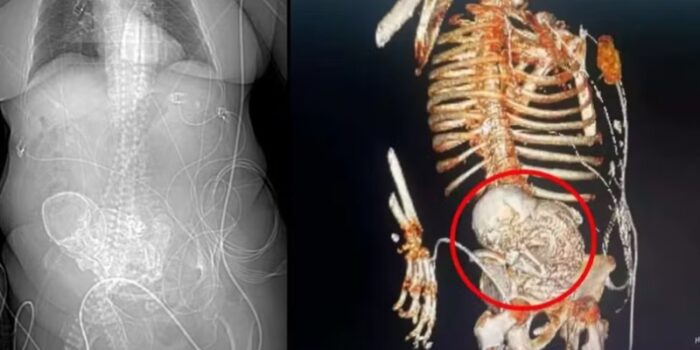 WhatsApp-Image-2024-03-20-at-06.21.40-700x350 ‘Bebê de pedra’: idosa descobre feto calcificado que carregou por mais de 5 décadas e morre após cirurgia de retirada