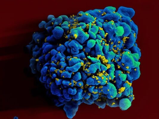 hiv_celula_infectada-1-533x400 Nova variante do HIV é detectada na Bahia, no Rio de Janeiro e no Rio Grande do Sul